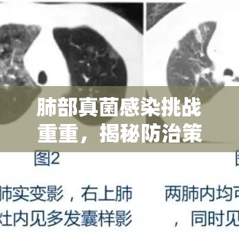 肺部真菌感染挑战重重,揭秘防治策略与最新头条新闻